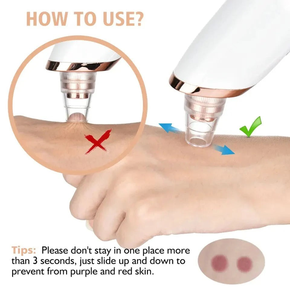 Black head Remover - 5 in 1 Rechargeable Blackhead Remover - Acne Remover - Vacuum Suction
