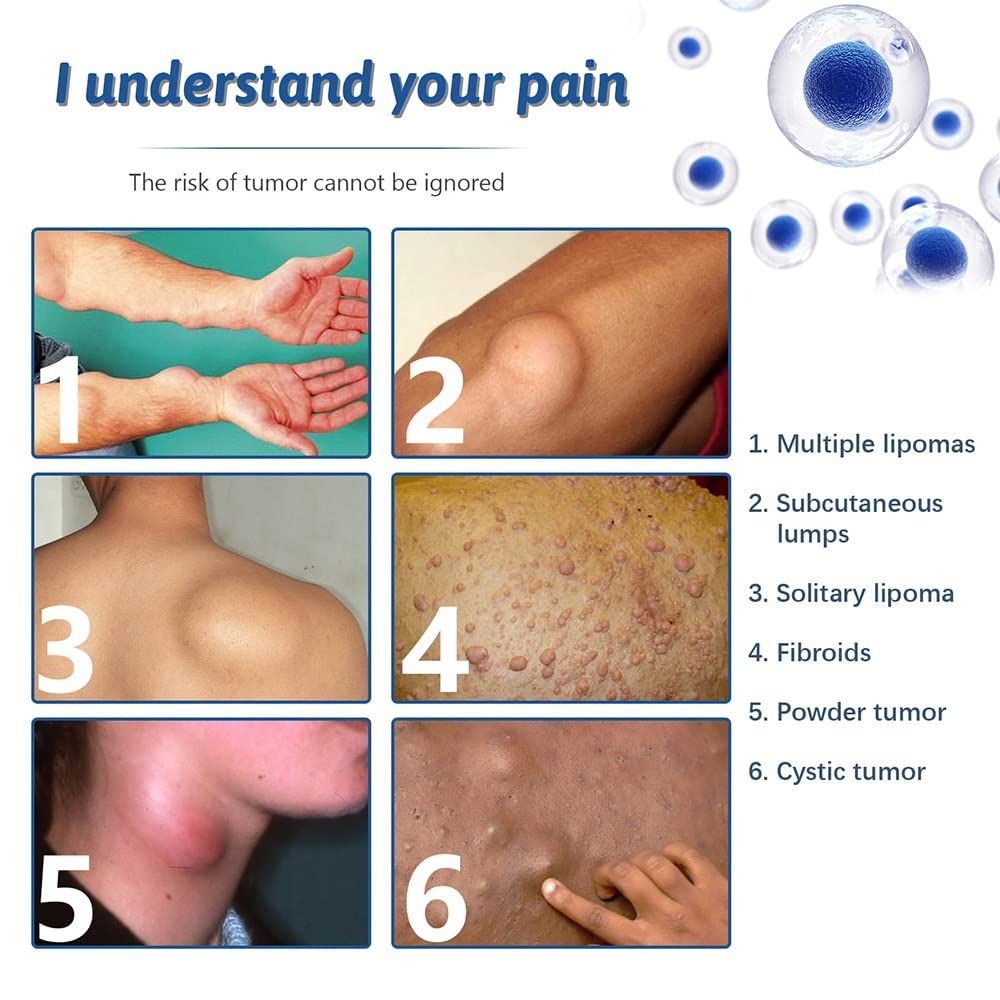 Lipoma Removal Cream | Non-Surgical Lipoma Remover Cream