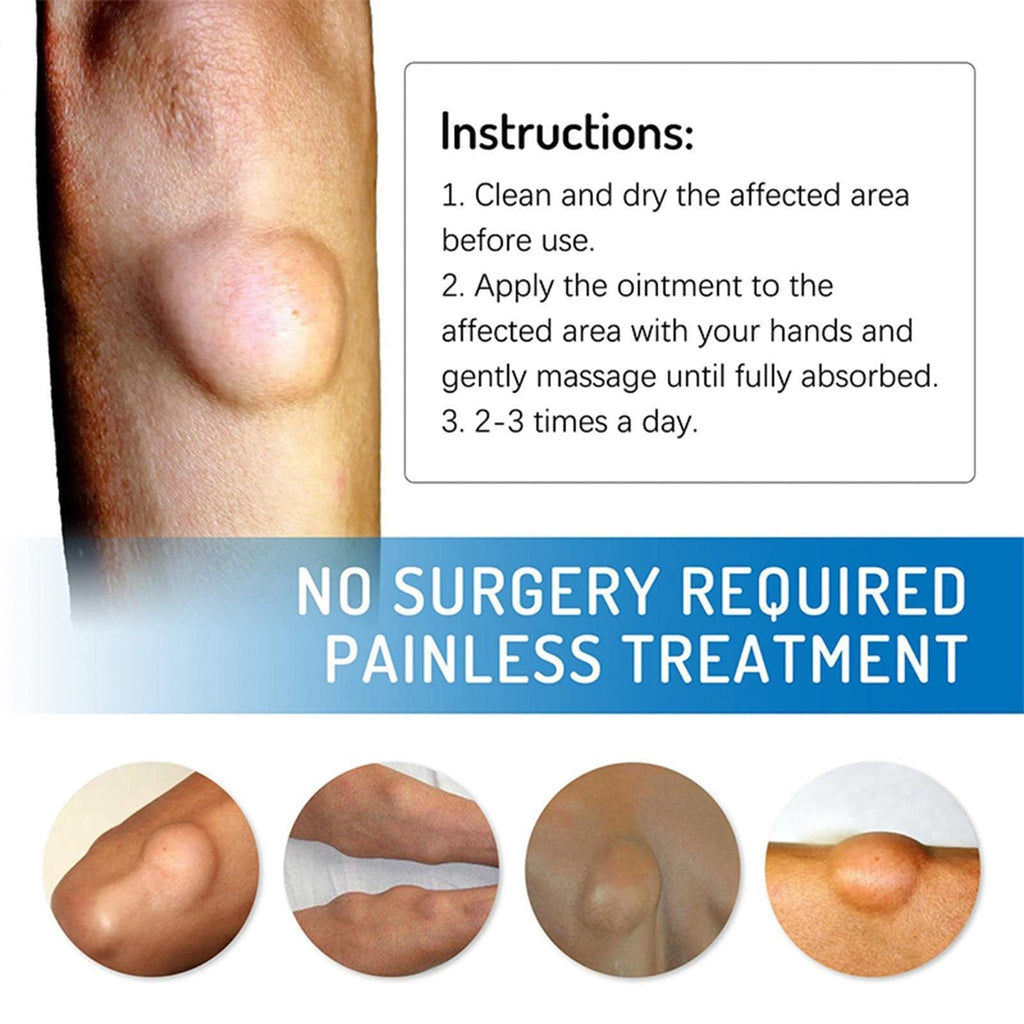 Lipoma Removal Cream | Non-Surgical Lipoma Remover Cream